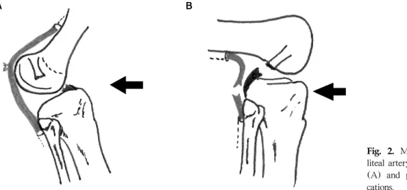 Fig. 2.  Mechanism  for  pop- pop-liteal artery injury for anterior (A)  and  posterior  (B)   dislo-cations.bilizer)에 의해 유지되며, 대퇴골 및 경골 사이의 접촉 면적(contact area)를 증가시켜 주는 반월상 연골도 슬관절 안정성에 기여한다