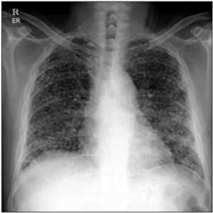Figure 1. The initial chest  X-ray showed  multiple nodular opacities  in  the  whole  lung  field.