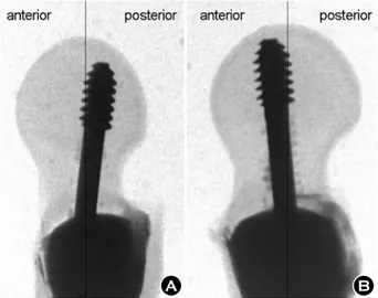 Fig. 3. The position of  lag screw in femoral head &amp; neck.  (A) Group 1 (anterior to posterior)