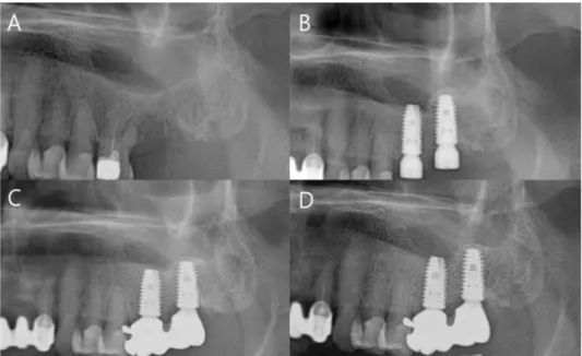 Fig. 1.  (A)Pre-op. (B) Fixture installation. (C) 2 months after setting of final prosthesis