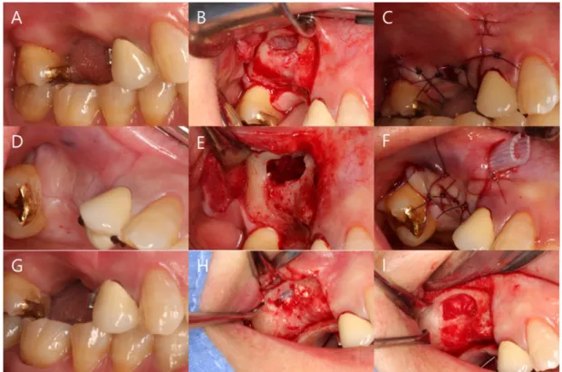 Fig. 5.  Case 2. (A) Pre-op. (B) Lateral window with full-thickness flap elevation. (C) Sinus lift with  xenograft