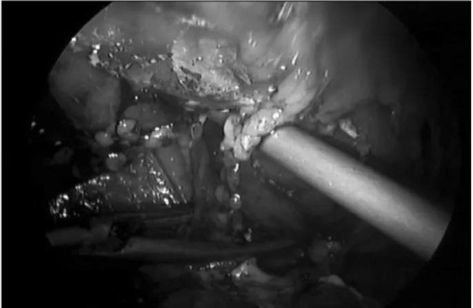 Fig.  1.  In  vivo  laparoscopic  appearance  of  the  tumor  model 
