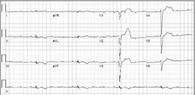 Fig.  2.  Electrocardiogram  following  insertion  of  electronic  ventri-