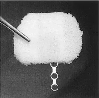 Figure 2. A well-positioned Medpor Ⓡ  channel sheet implant  over the bony defect with the end of the microplate resting  on a stable bone.