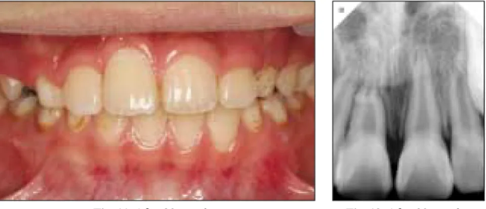Fig. 11. After 20 months. Fig. 12. After 20 months.