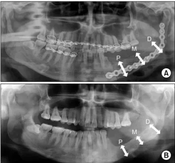Fig. 1. Methods of measurement. (A) Immediate panoramic view after nonvascularized iliac bone graft