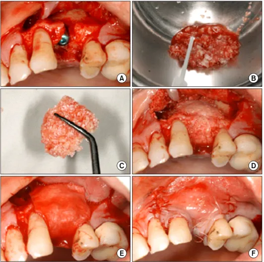 Fig. 1. An example of the basic pro- pro-cedures for implant installation  with guided bone regeneration