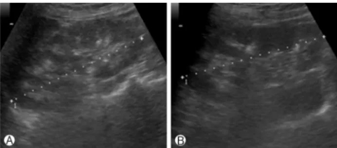 Fig. 1. Ultrasonographic finding of both kidney.  (A) Right kidney,  (B) left kidney. Echogenecity of both renal medulla was increased.
