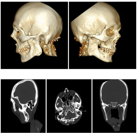 Fig. 2. Preoperative visualized 3 di- di-mensional display based on  com-puted tomography
