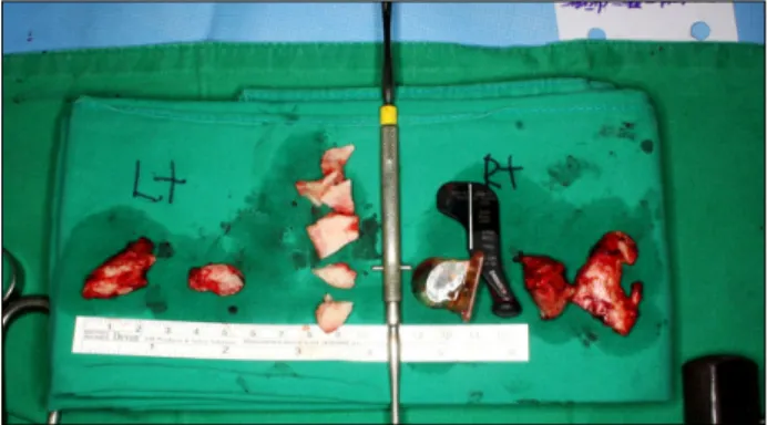 Fig. 4. Operating table tilted by 60 degrees caused the rigidity of his lumbar ankylosing spondylitis.