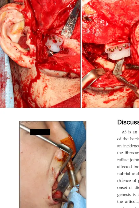 Fig. 6. Joint replacement by Biomet Ⓡ Microfixation temporomandibular joint Replacement System (Biomet  Microfix-ation, Jacksonville, FL, USA).