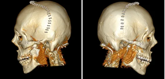 Fig. 8. Postoperative visualized 3 di- di-mensional display based on  com-puted tomography.