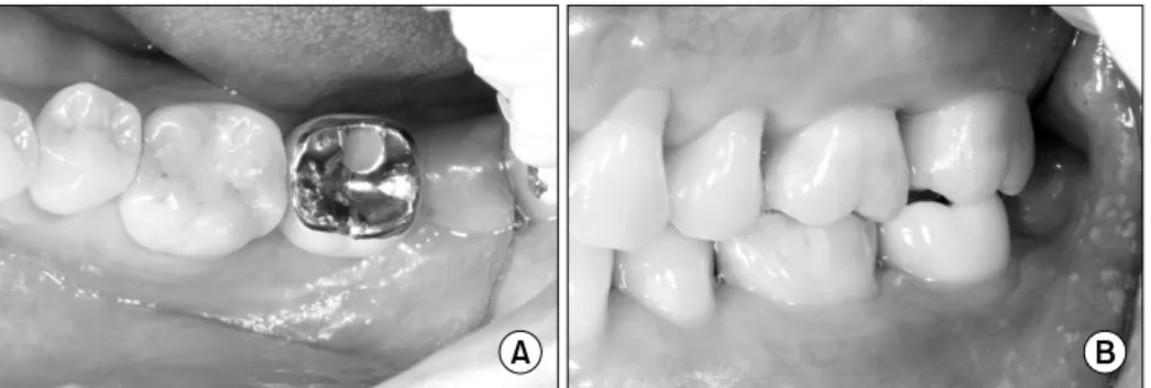 Fig. 4. Second operation was done after 13 months later. Excellent bone healing was observed.