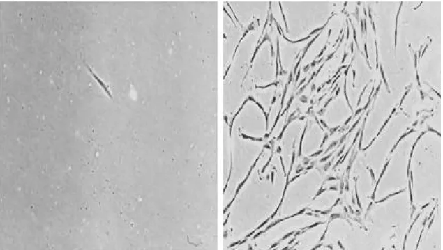 Fig. 1. Microscopic finding of bone marrow cell just after irrigated from bone marrow (left)