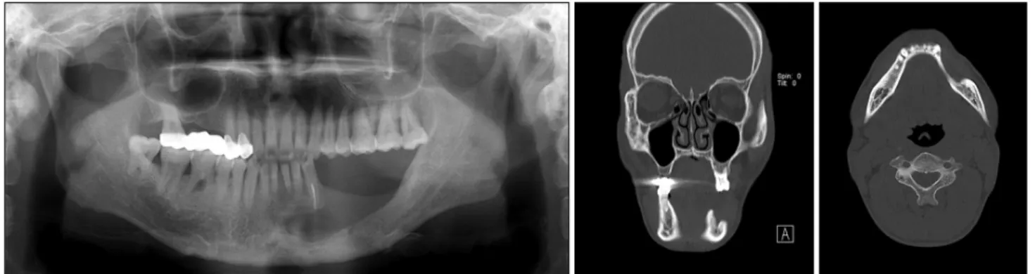Fig. 1. Pre-operative panoramic view &amp; conebeam computed tomography.
