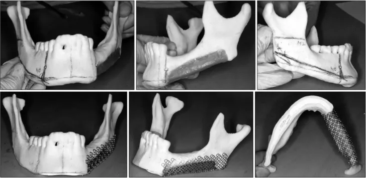 Fig. 7. Rapid prototype model analysis, model surgery &amp; titanium mesh bending for left mandibular defect area.