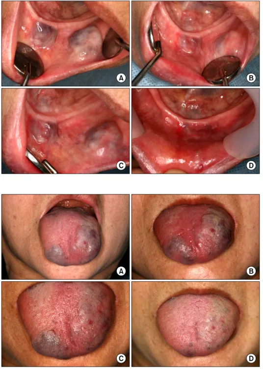Fig. 4. (A) First injection, (B) 4th  injection of 1.25% ethanolamine  oleate on left side of tongue