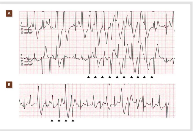 Figure 1. Bidirectional VT was noted on Holter monitoring (A). Non-sustained bidirectional VT was also induced during