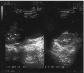 Figure 1. Abdominal ultrasonography. It shows huge cystic lesion in front of right kidney.