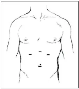 Fig. 1. Port insertion sites.