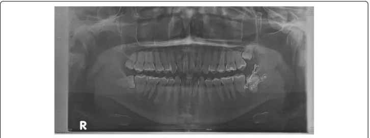Fig. 4 Postoperative panoramic radiographs treated with conventional plate