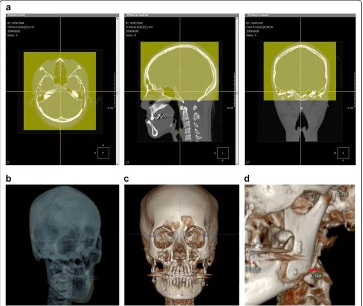 Fig. 4 In three-dimensional simulation software, serial 3D-CT data were superimposed automatically on the best fit of cranial base structures by using volume registration (a, b)