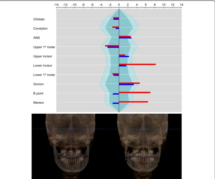 Fig. 6 Polygonal chart and 3D reconstruction images of case 1. The asymmetry index on orbitale was not changed because the 3D coordinate data of reference landmarks were maintained on the postoperative images