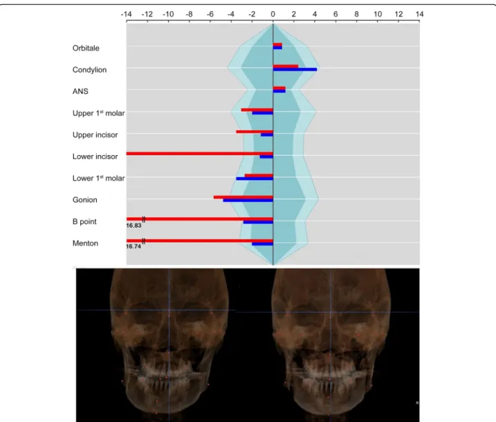 Fig. 8 Case 3. The asymmetry index on U1 was improved by midline correction of the maxilla