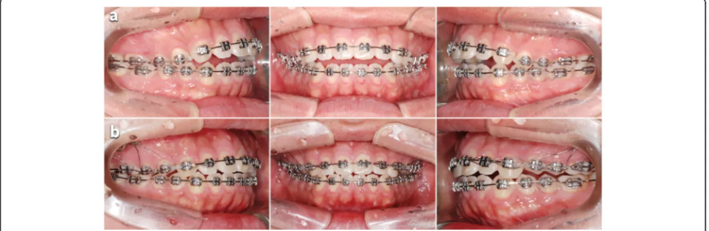 Fig. 3 Occlusal changes after the PMSO. a Before the PMSO. b After the PMSO