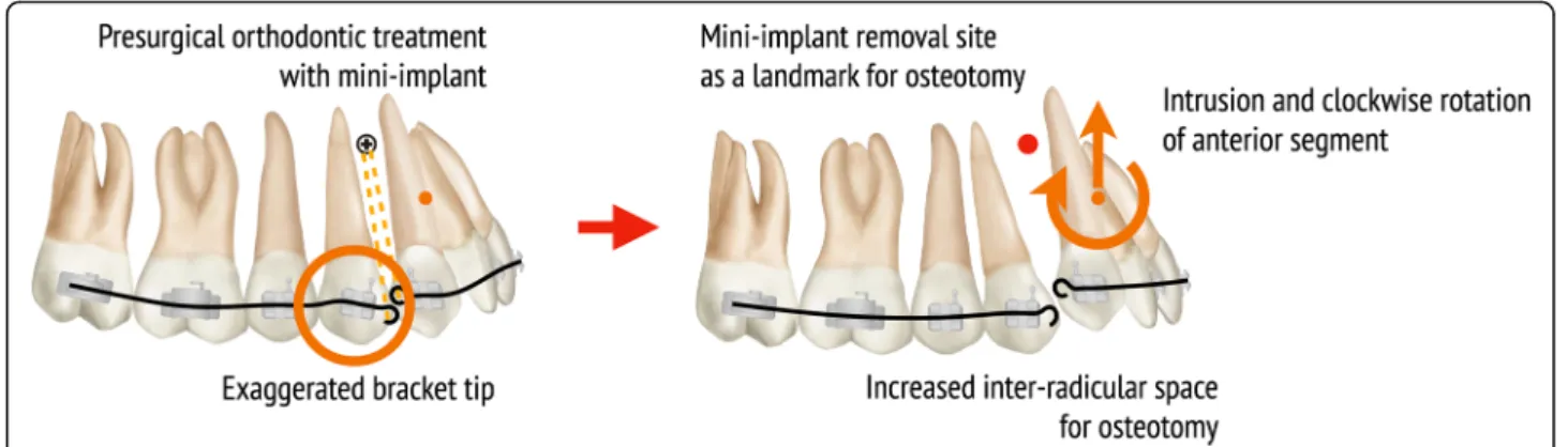 Fig. 8 Orthodontic strategy to avoid root damage during PMSO
