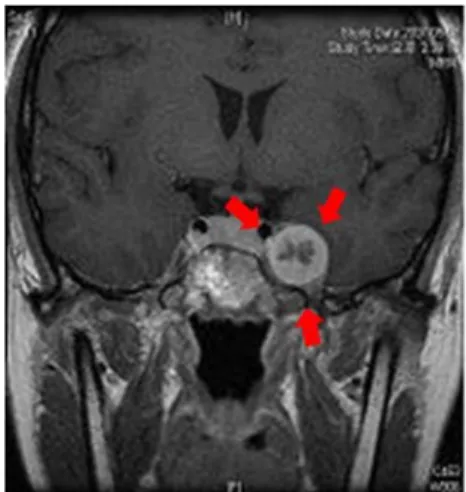 Fig.  7.  교근에서의  전이통(From  Simons  DG,  Travel  JG.  Myofascial  pain  and  dysfunction:  the  trigger  point  manual
