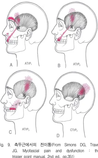 Fig.  9.  측두근에서의  전이통(From  Simons  DG,  Travel  JG.  Myofascial  pain  and  dysfunction  :  the  trigger  point  manual,  2nd  ed.,  pp.351)