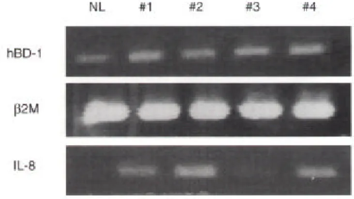 그림 4. 중이염 환자의 중이 상피세포에서의 염증발현 정도에 따른 hBD-2 mRNA에 대한 RT-PCR 소견. 정상에서는 거의 발현되지 않 았으나, 중이염 군에서는 대부분 hBD-2의 발현이 현저히 증가되었 다