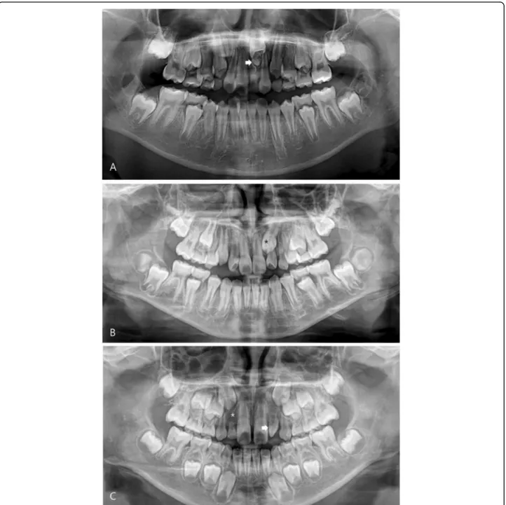 Fig. 1 Maxillary dental developmental abnormality. a Mesiodens (arrow). b Impacted maxillary canine (asterisk)