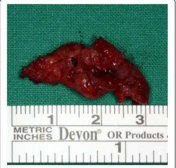 Fig. 6 Histologic features of the mass. a Dense collagenous tissue surrounds the osseous trabeculae and peritrabecular clefting is present (H and E stain, original magnification: × 100)