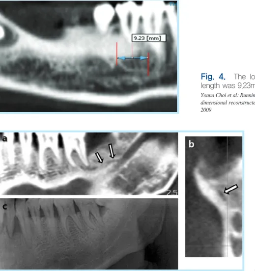 Fig. 4.  The longest anterior loop in this study. The length was 9.23mm.