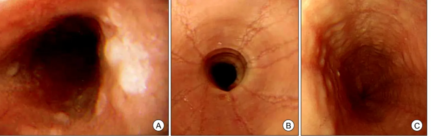Figure  1.  Endoscopic  findings.  (A)  It  shows  multiple  whitish  papules  at  31  cm  from  upper  incisor  resembling  small  patches  of  Candia 