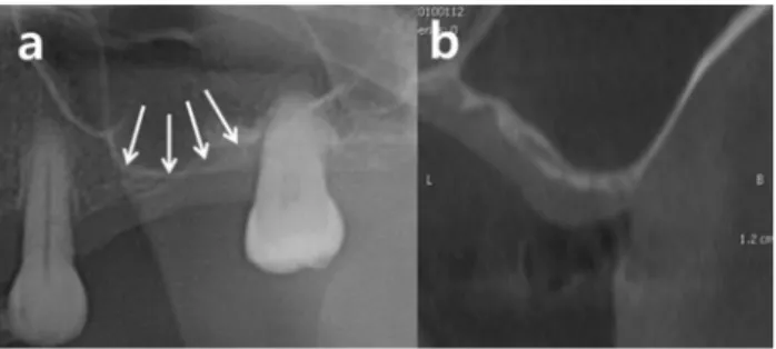 Fig. 1.  The initial panoramic radiograph showed advanced periodontitis  with apical involvement on the left maxillary second premolar and first  molar, which were decided to be extracted.