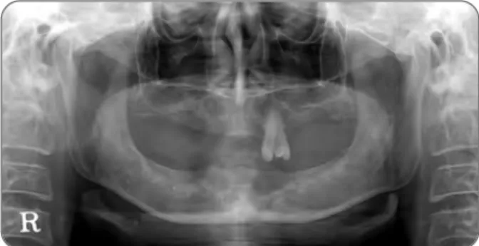 Fig. 1. Panoramic radiographic view and intraoral view in  patient at initial visit