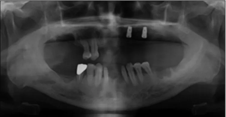Fig. 1. Panoramic radiograph at first visit. Fig. 2. Panoramic radiograph after implant surgery.