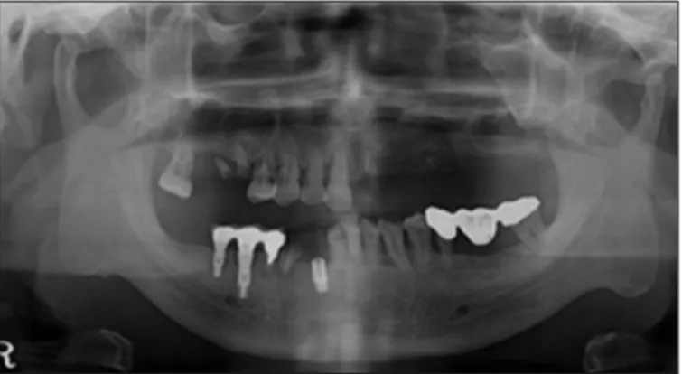 Fig. 7. Panoramic radiograph at first visit. Fig. 9. Panoramic radiograph after implant surgery.