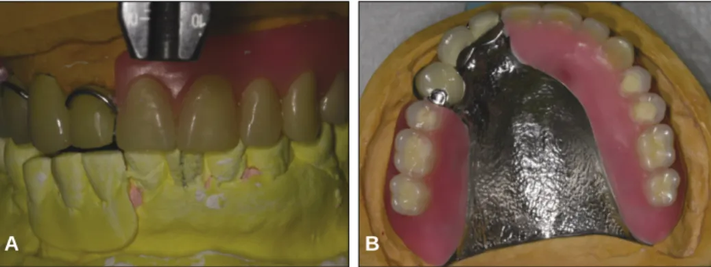Fig. 11. Mounted master cast and artificial teeth arrangement (A) Artificial teeth arrangement (frontal view), (B)