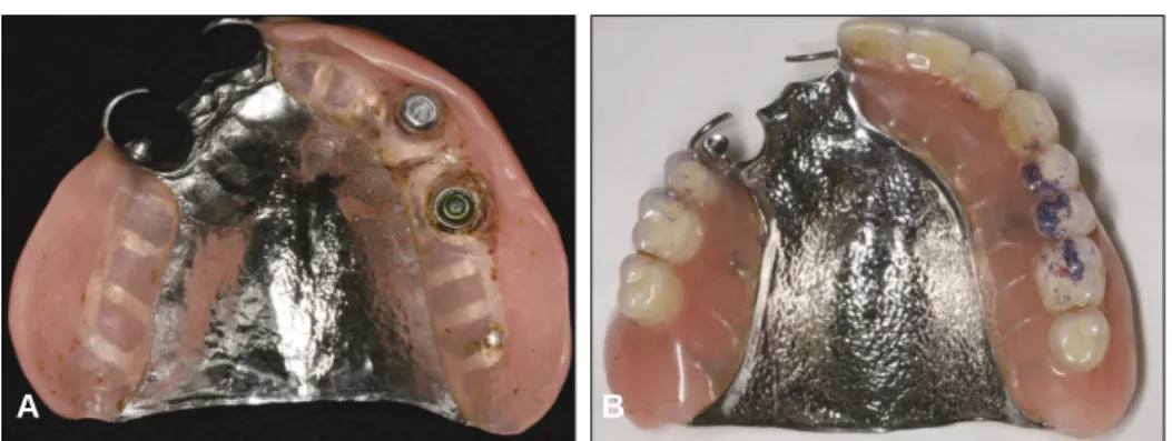 Fig. 14. Periapical radiograph 2 years and 6 months after delivery. Vertical bone loss was on #22 area
