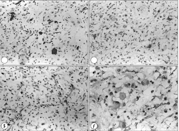 Fig. 5. Neurofilament(5A) and synaptophysin(5B) positive neurons. GFAP(5C) and S-100 protein(5D) positive astrocytic cells and 