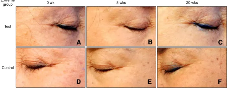 Fig. 6.  Clinical photographs of the face of a 67-year-old Korean woman (patient 16). (A∼C) Test material patch using side at the  week  0,  week  8  and  week  20,  respectively