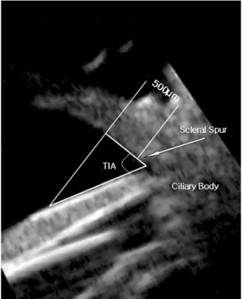 Figure  1. Trabecular-iris  angle  (TIA)  depicted  on  an  ultrasound biomicroscopic (UBM) image of a normal eye.