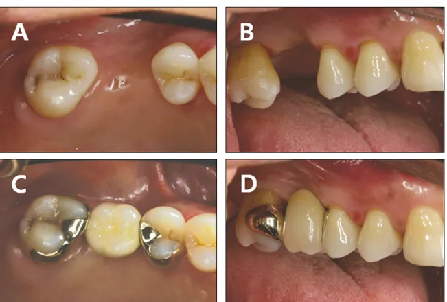 Fig. 3. Preoperative intraoral photo of 1 st molar missing area (A, B). Abutments are showed different long axis