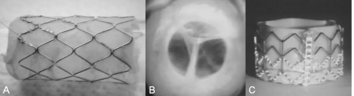 Fig. 5. Unfolded features of percutaneous pulmonary valve (A, B) and aortic valve (C).