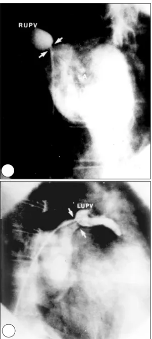 Fig. 5. Selective angiogram of right upper pulmonary