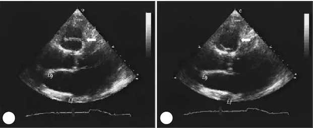 Fig. 1. Transthoracic echocardiographic parasternal long axis view showing bicuspid pulmonic valve (arrow) at